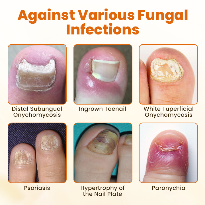 🎅Christmas Hot Sale🔥 FungiBee Advanced Nail Repair Spray