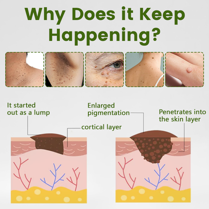 🎅Christmas Hot Sale🔥 ThujaClear Botanical Wart Cream