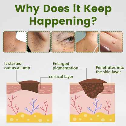 🎅Christmas Hot Sale🔥 ThujaClear Botanical Wart Cream