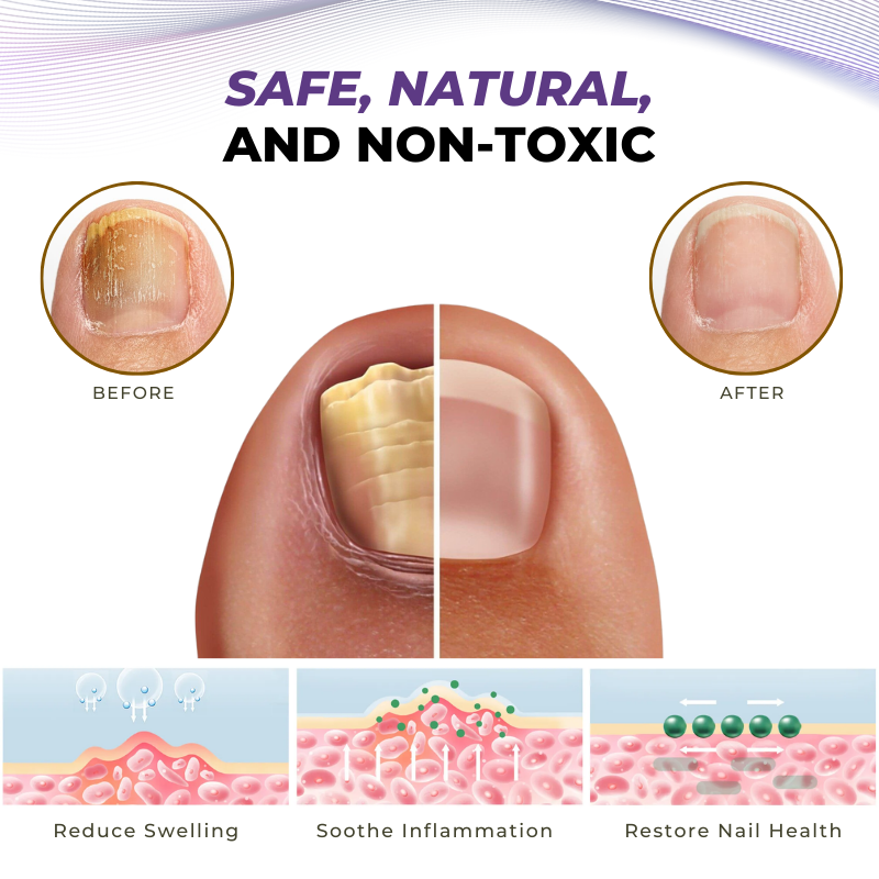 🎅Christmas Hot Sale🔥 MycoOut Natural Nail Fungus Solution